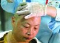 母親割皮救子 39歲的母親唐淑金救兒整個頭皮植到