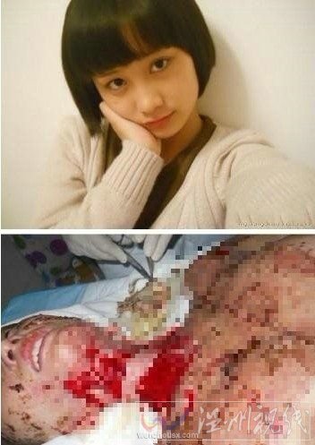 周巖被燒傷前后對比（圖片來自家屬李聰微博）