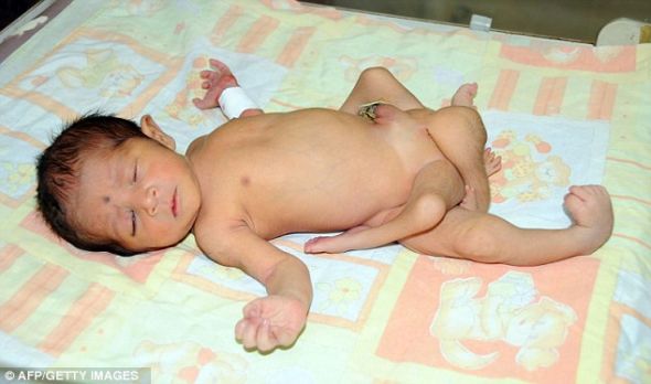 六條腿嬰兒