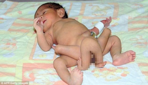 六條腿嬰兒