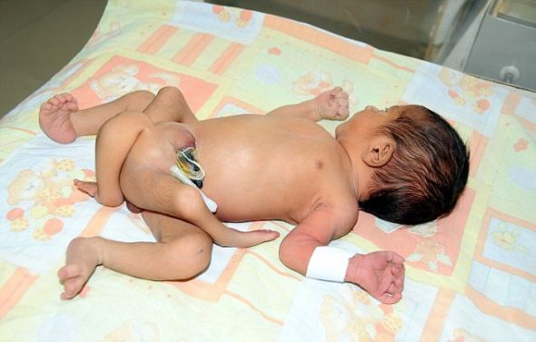 六條腿嬰兒