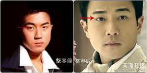 整容部位三：雙眼皮