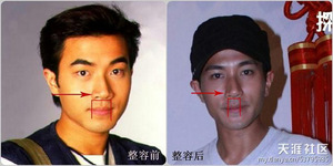整容部位五，嘴唇 (縮唇，改變唇形)