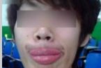 男子遭蝙蝠偷吻 遼寧一男子被蝙蝠偷吻后變香腸嘴