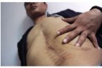 男子左腎失蹤 湖南25歲男子接受脾臟切除手術左腎不