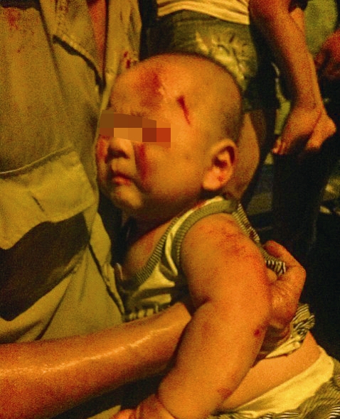 男嬰身上多處受傷