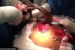 巴西男子腸道內取出活魚 被取出時還在蠕動