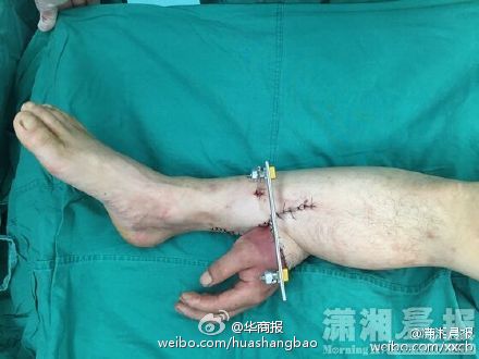 現(xiàn)實版寄生手掌