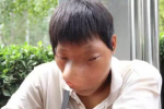 河南大學(xué)生患怪病骨纖維瘤和垂體瘤