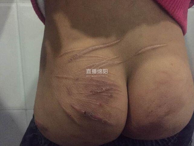 女孩被養父母虐待