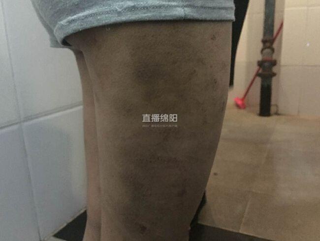 女孩被養父母虐待