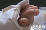 男童連續(xù)高燒8年 怪病男童無痛感無汗