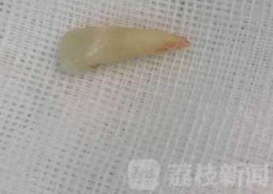 女孩牙齒飛入眼眶