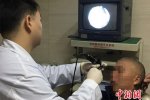 鼻腔取出5cm螞蝗 好嚇人啊