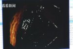 女子減肥藥當(dāng)飯吃致結(jié)腸