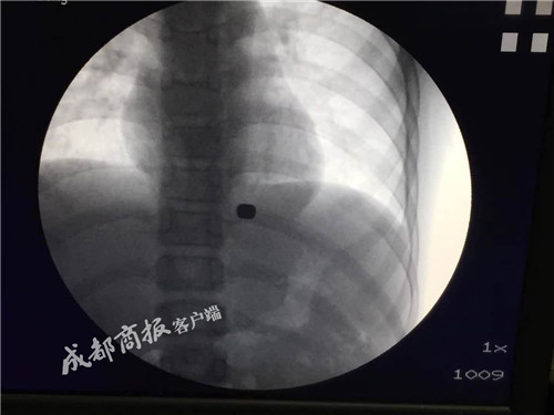 男孩胃里取出磁鐵