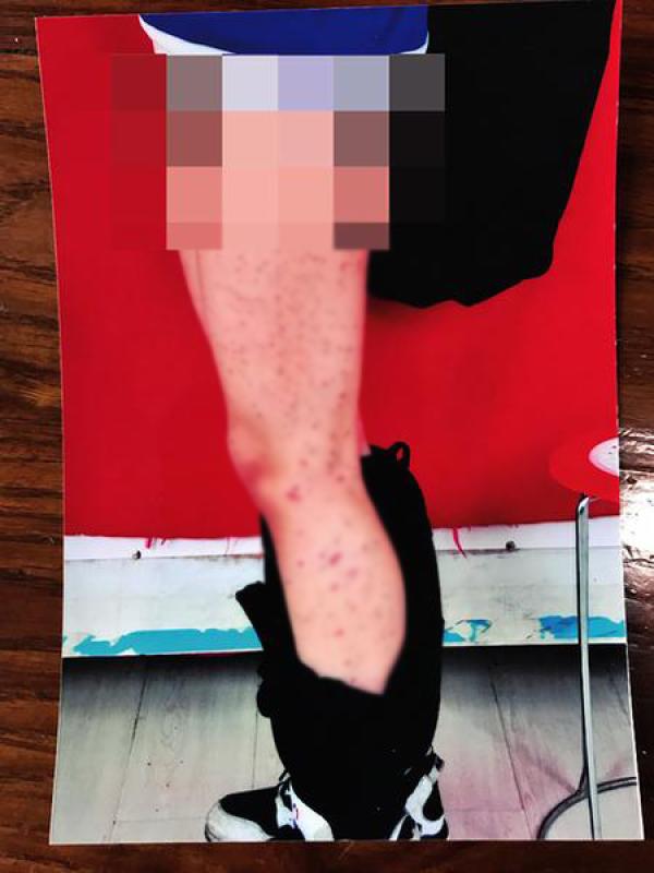 女生被同桌用筆扎得滿腿是傷