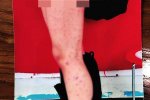 用筆扎得滿腿是傷 漢臺中學女生被同桌男生欺凌