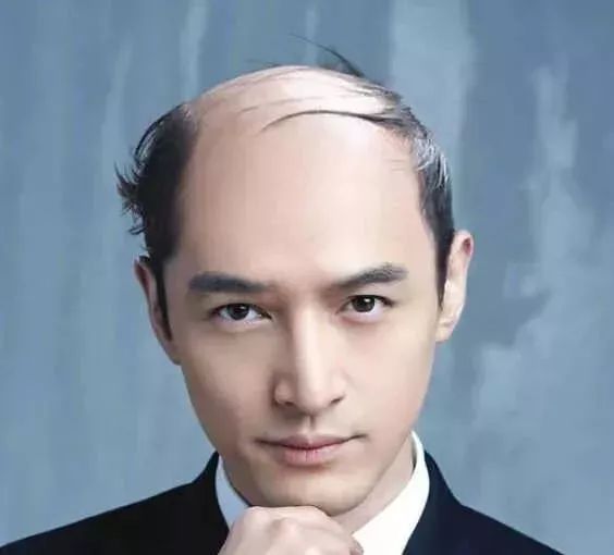 脫發(fā)更長壽上熱搜