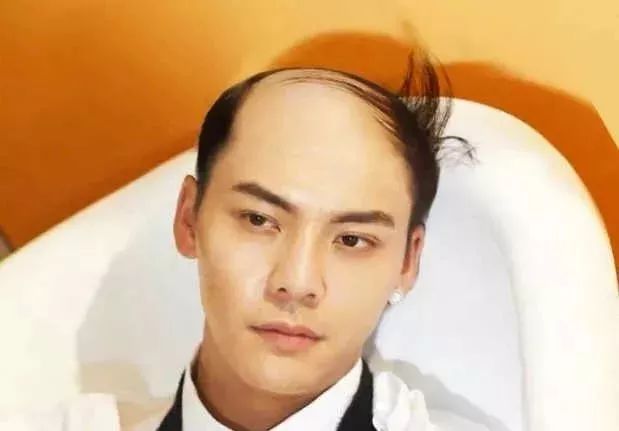 脫發(fā)更長壽上熱搜