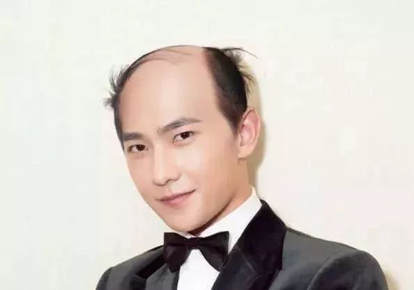 脫發(fā)更長壽上熱搜