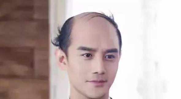 脫發(fā)更長壽上熱搜