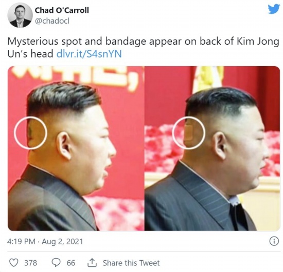 金正恩后腦的繃帶和斑點
